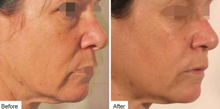 Skin Tightening